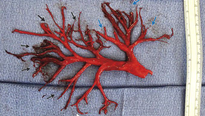 Man coughs up giant lung-shaped blood clot