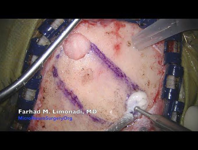 Brain surgery: Interhemispheric Transcallosal Craniotomy separating two hemispheres of the brain