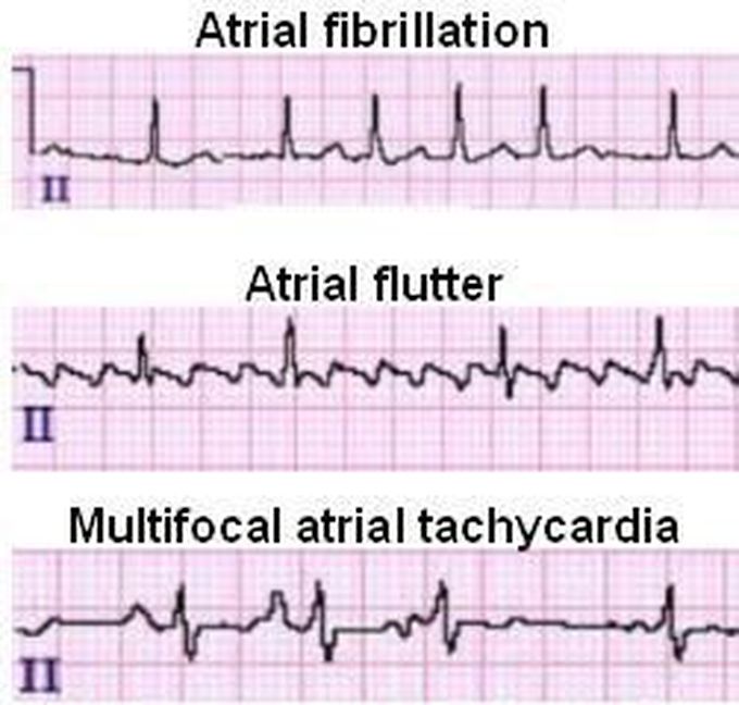 The types of arrythmias according to origin:              A-atrial arrytmias: 1- atrial tachycardia in which there is multiple waves of PQRST waves repeated.    2-atrial bradycardia there is decrease number of PQRST.                                                                               3-atrial flutter(250-350 Beat/minuets) multiple P wave( or called F wave) follow by QRS wave.                                             4-atrial fibrillation (more than 350 beat/minuets) No p wave (or called f wave)