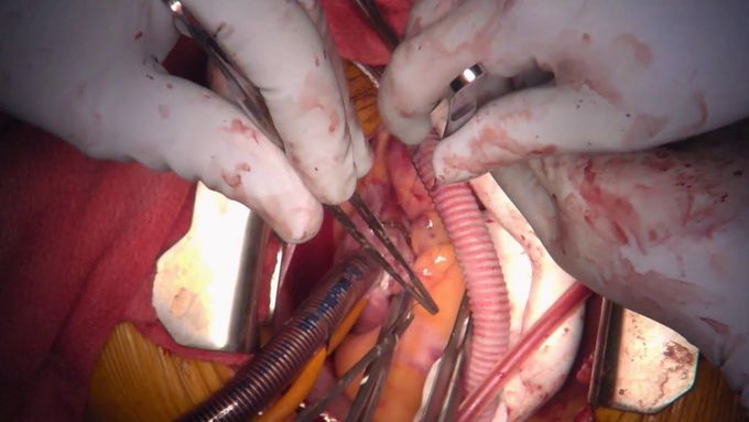 Novel Cannulation Technique for Temporary Right Ventricular Assist Device After LVAD Placement