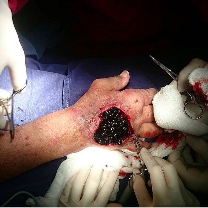 Hematoma on the hand