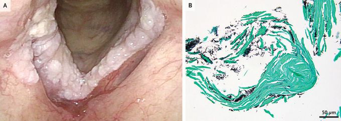 Laryngeal Candidiasis