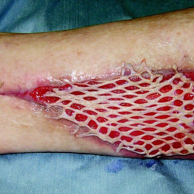 Mesh skin graft