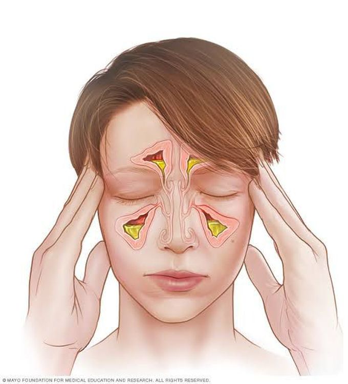 Causes of sinusitis