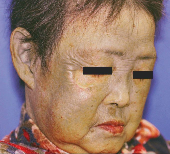 Minocycline-Induced Hyperpigmentation