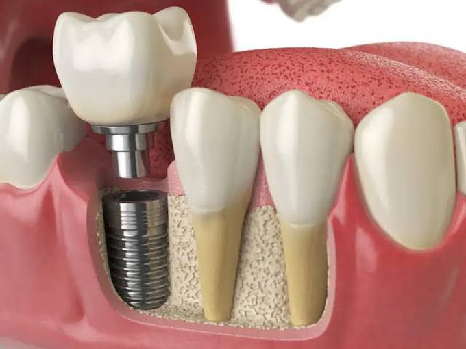 Why dental implant surgery is done?