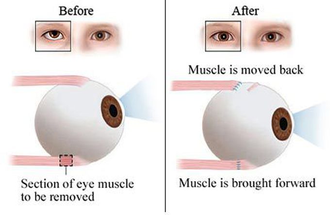 Treatment for Strabismus