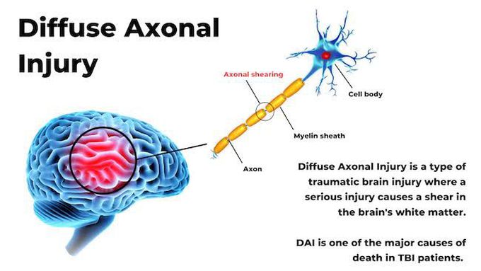 Treatment of diffuse axonal injury
