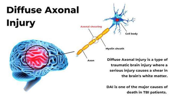 Treatment Of Diffuse Axonal Injury MEDizzy