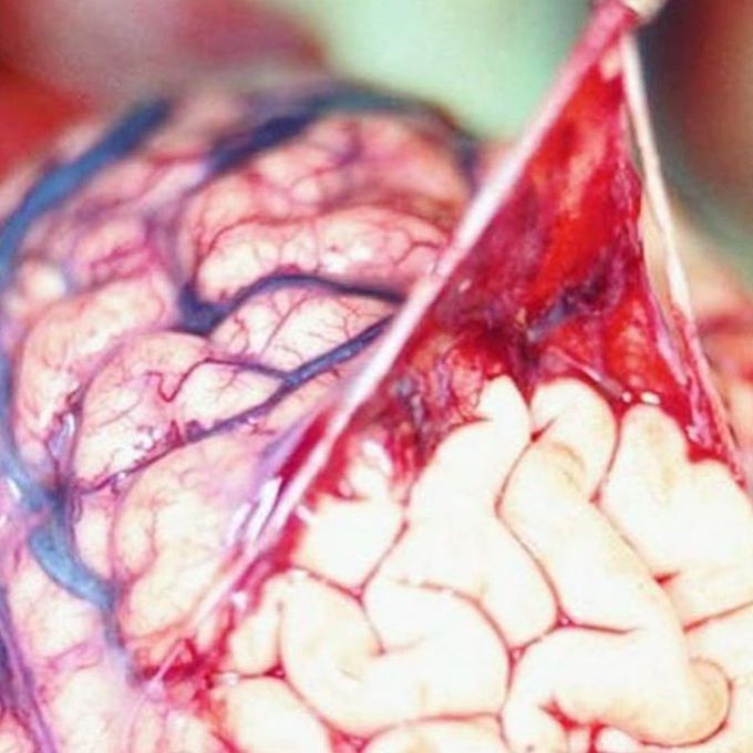 Arachnoid membrane