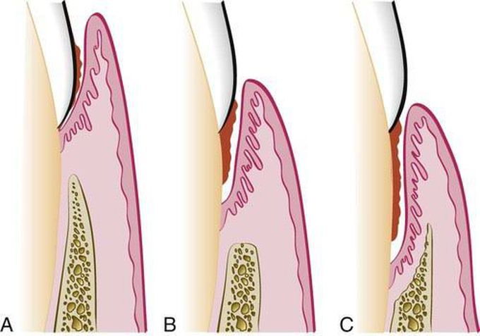 Periodontal pockets