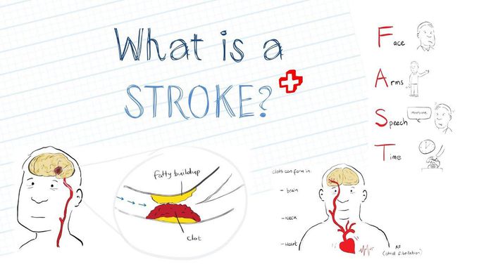 Stroke