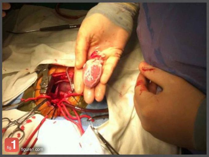 Pediatric heart transplant!!!