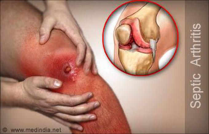 Septic Arthritis