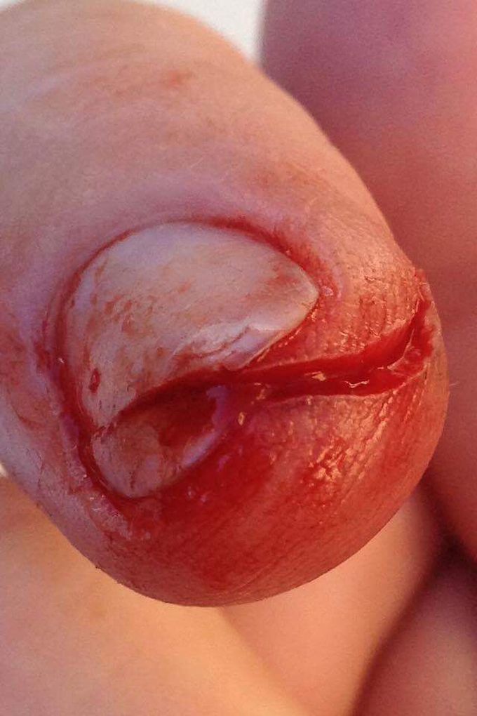 Sliced my finger with a hedge trimmer