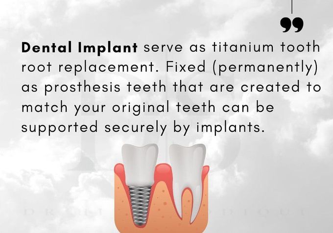 Dental Implants