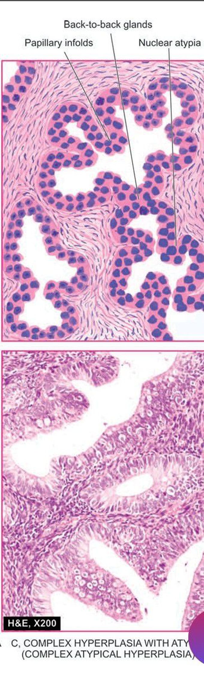 Endometrial hyperplasia