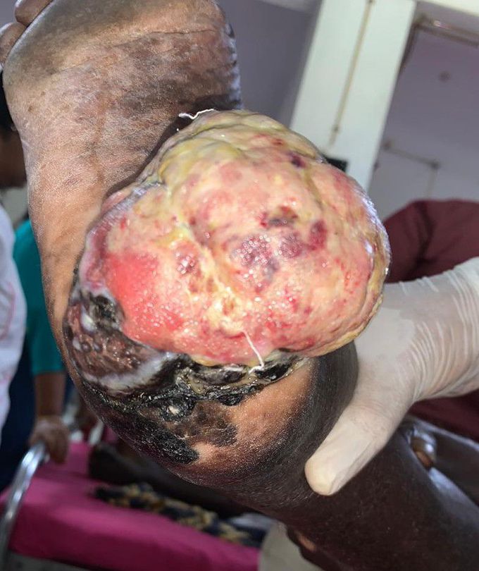 A case of malignant melanoma