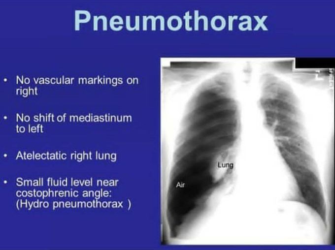 Pneumothorax