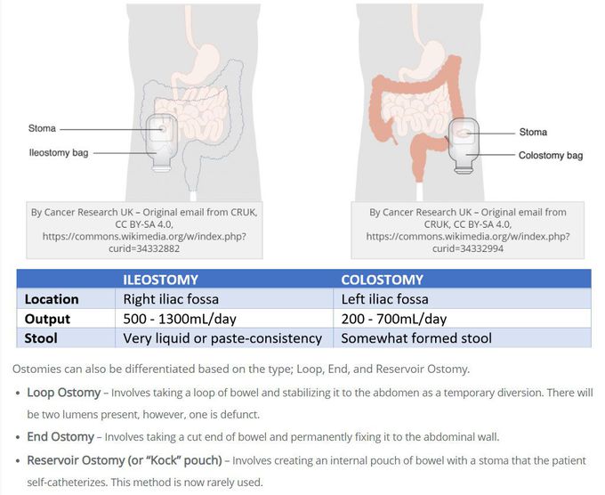 Colostomy vs Ileostomy