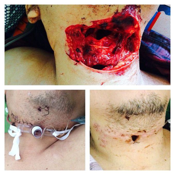 Trakeal trauma 