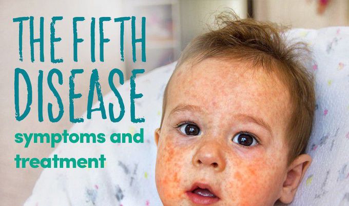 Symptoms of Erythema infectiosum