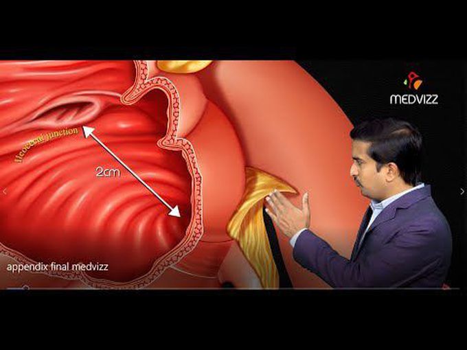 Gross anatomy of Appendix - animated anatomy