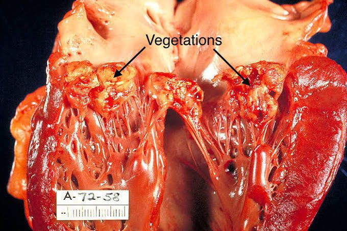 Infective endocarditis