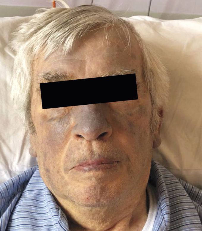 Skin Discoloration from Amiodarone