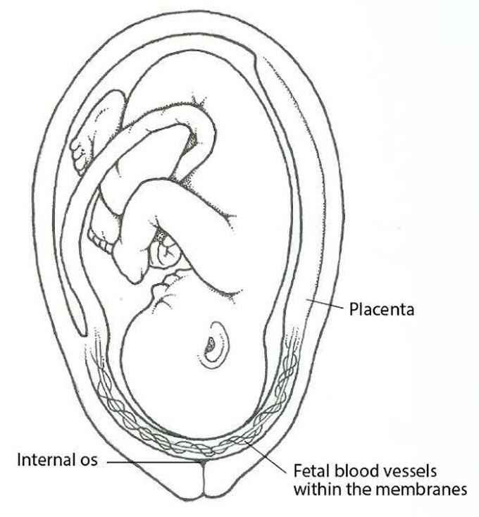 Causes of vasa previa