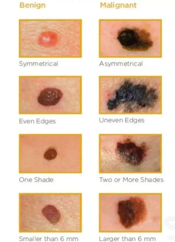 Benign and Malignant Skin Lesions