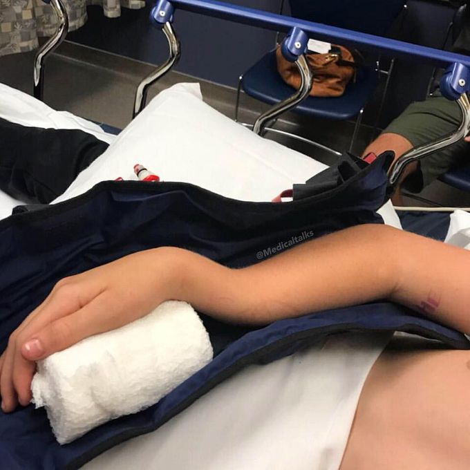 Ouch, radius and ulnar shaft fracture, aka broken forearm!!!
