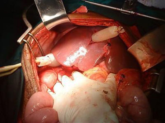 Liver injury