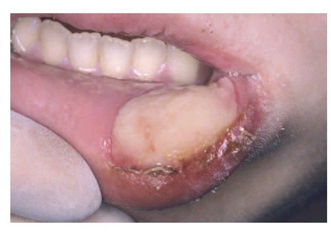 Traumatic ulcer