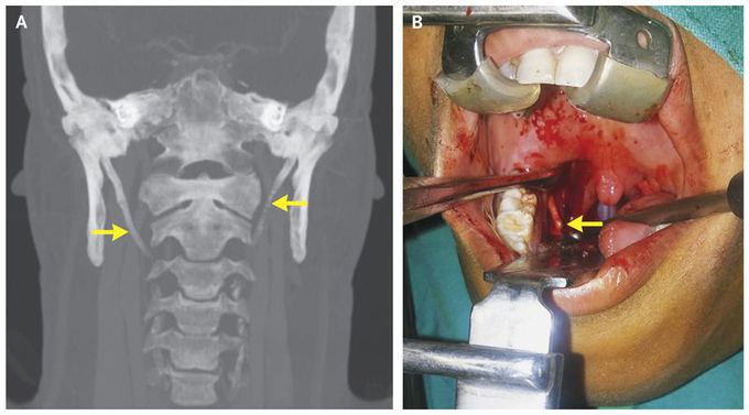 Eagle’s Syndrome