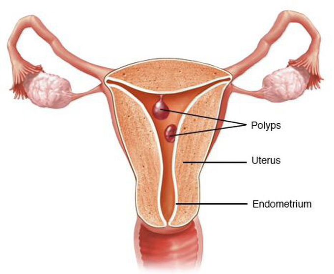 Uterine Polyps