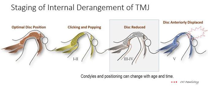 Symptoms of internal derangement