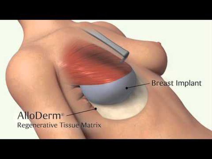 Alloderm Breast Reconstruction - 3D 
model