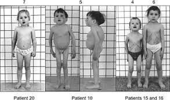 Gaucher Disease