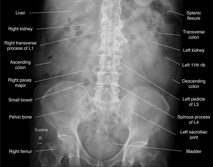 KUB X-ray