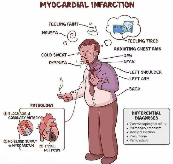 Myocardial Infarction MEDizzy
