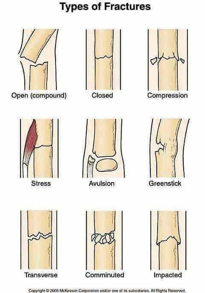 Types of fractures bones