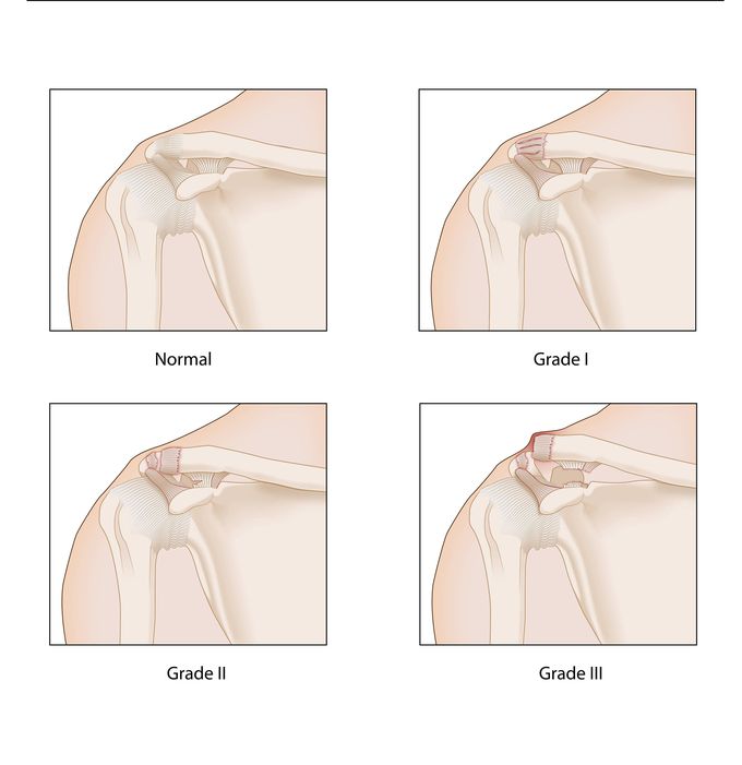 Degree of shoulder separation