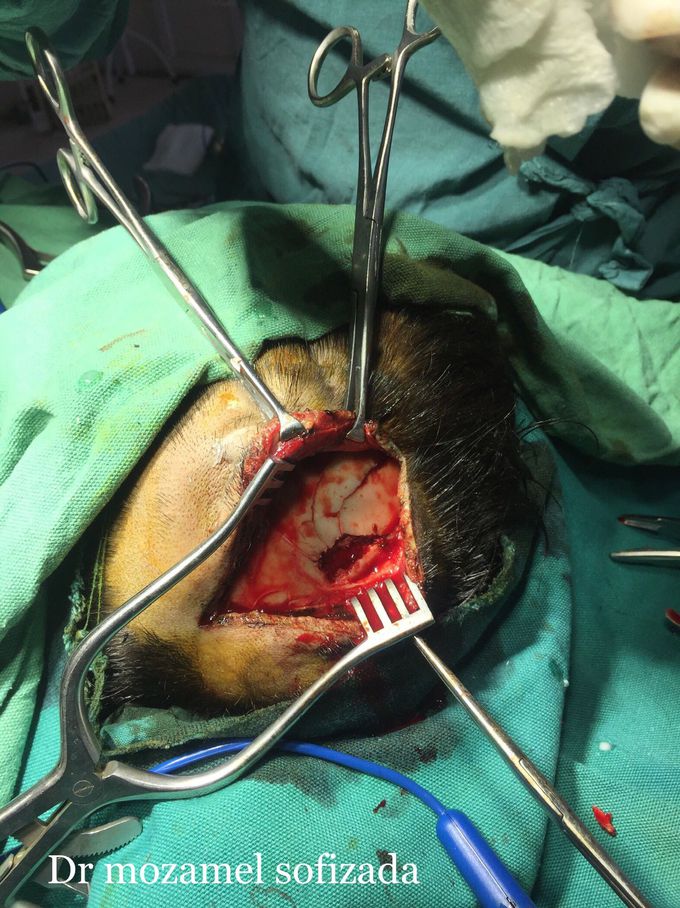 Head depressed fracture