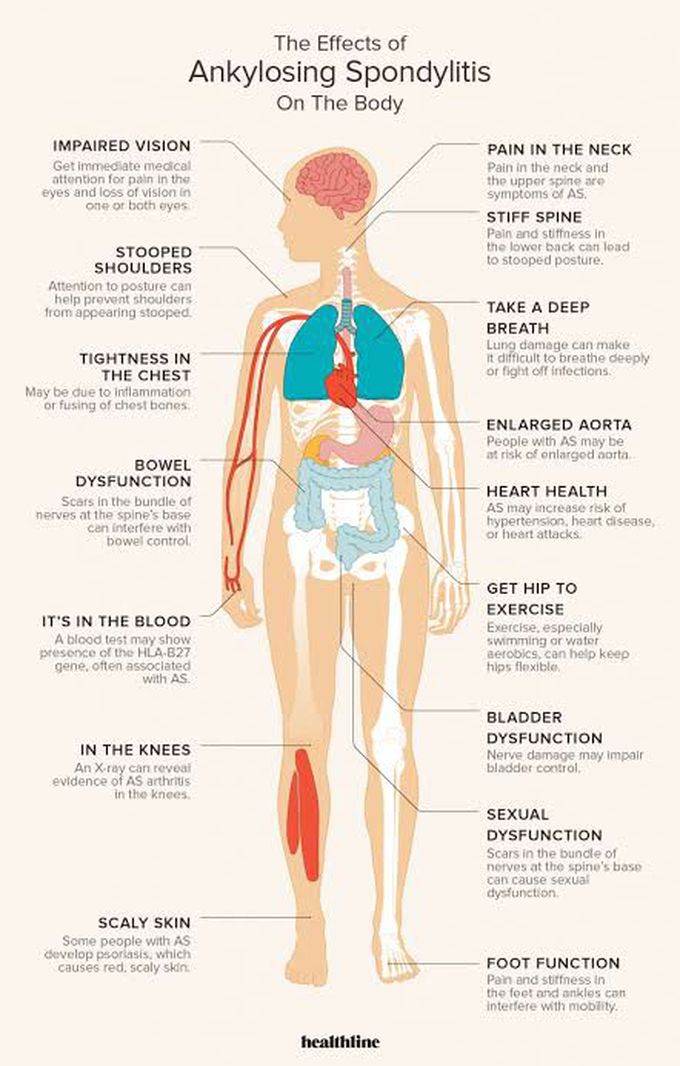 Causes of spondylitis