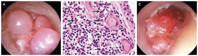 Eosinophilic Otitis Media