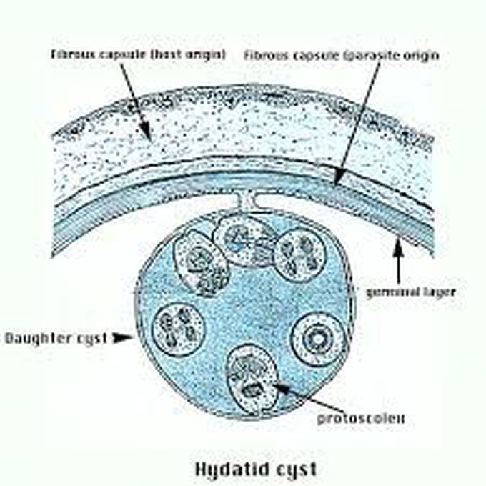 Symptoms of hydatid cyst