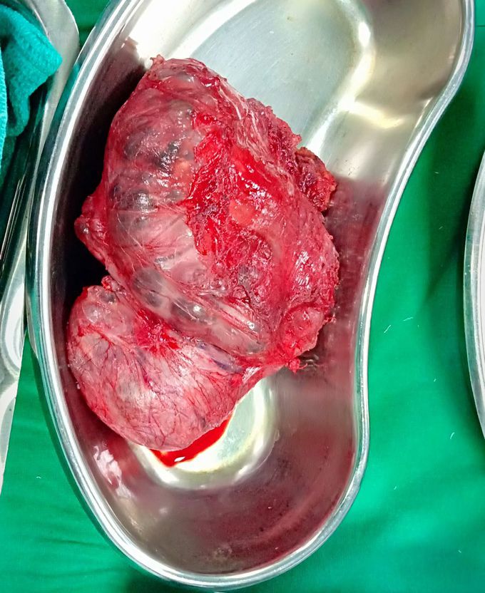Benign enlargement of thyroid glad resection done by subtotal thyroidectomy