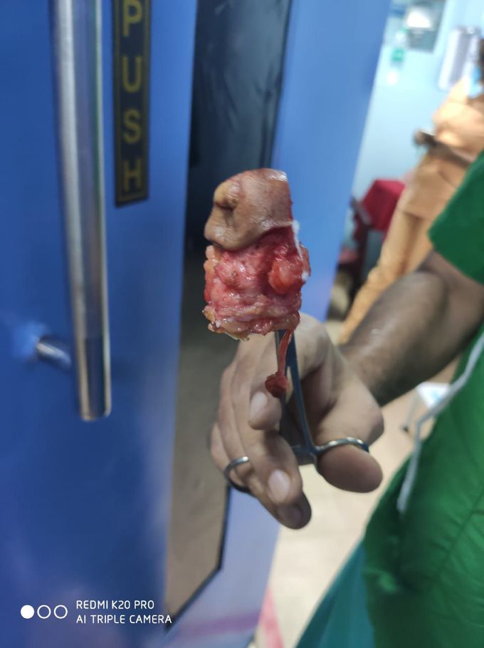 Umbilical hernia