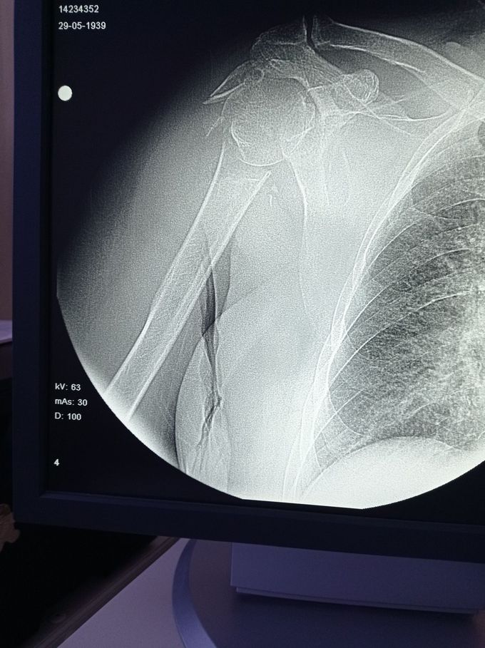 humerus head fracture